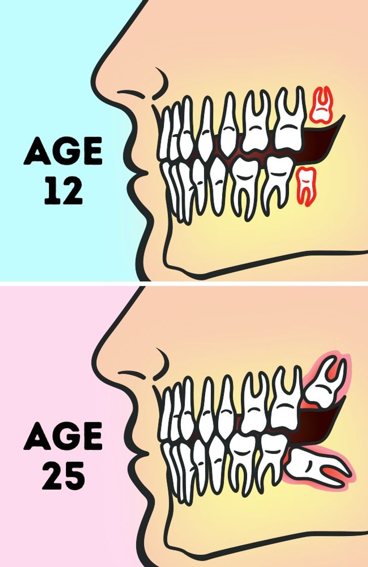 Do We Really Need to Remove Wisdom Teeth? HealthW