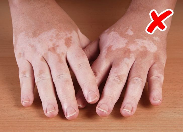 6 Signs Of Serious Diseases Signaled By Our Skin
