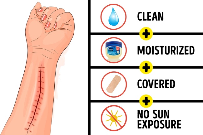 7 Hacks to Remove All Types of Scars and Help Them Heal