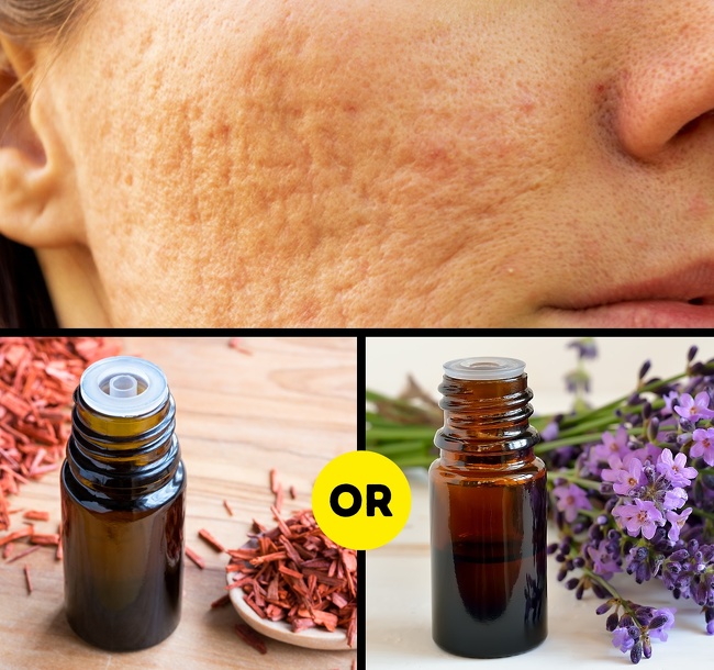 7 Hacks to Remove All Types of Scars and Help Them Heal