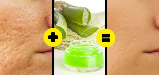 7 Hacks to Remove All Types of Scars and Help Them Heal