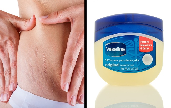 7 Hacks to Remove All Types of Scars and Help Them Heal