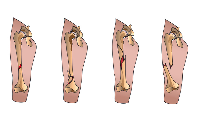 6 Signs You Might Have a Protein Deficiency