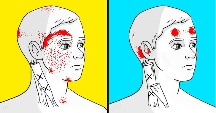 5 Diet Mistakes That Can Trigger Severe Headaches and Migraines