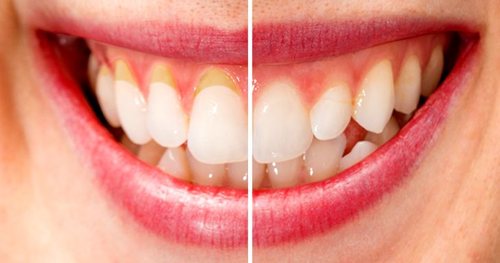 If You Have Receding Or Unhealthy Gums, Here Are Proven Solutions