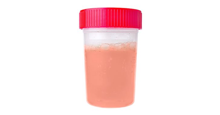 5 Things Your Pee Is Trying to Tell You About Your Health