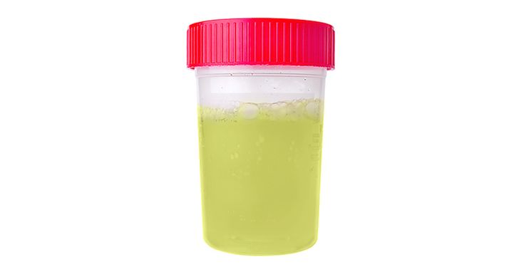 5 Things Your Pee Is Trying to Tell You About Your Health