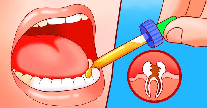 6 Home Remedies to Kill a Toothache