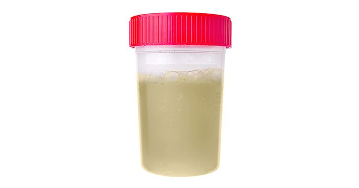 5 Things Your Pee Is Trying to Tell You About Your Health