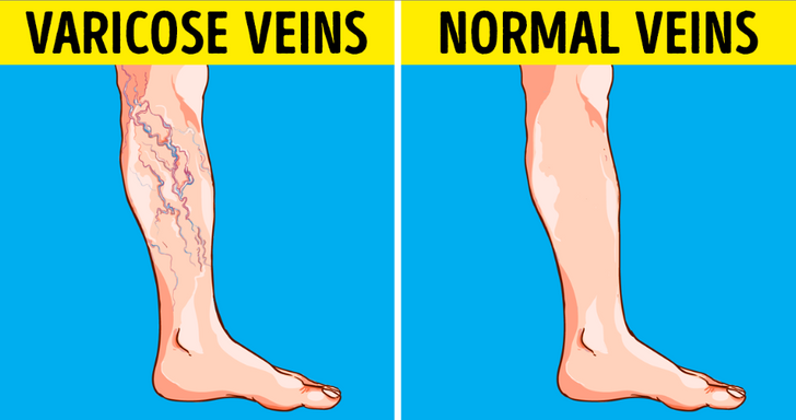 5 Ways to Get Rid of Varicose Veins at Home