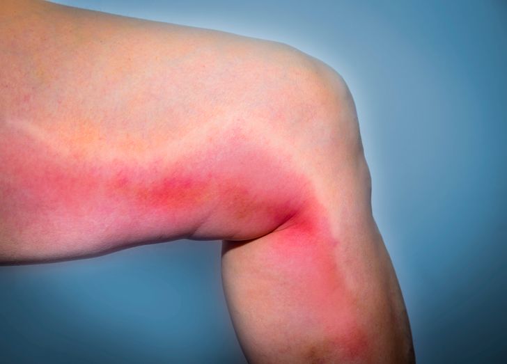 6 Warning Signs of a Blood Clot That Can’t Be Ignored