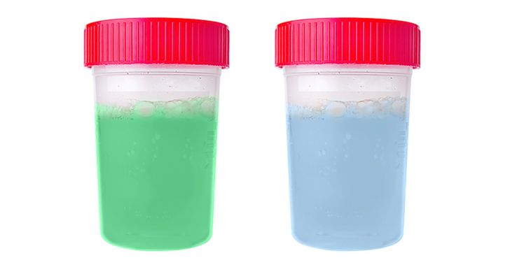 5 Things Your Pee Is Trying to Tell You About Your Health