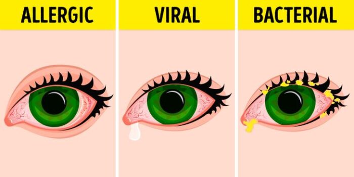 14 Effective Ways To Treat And Prevent Eye Infections Naturally Healthw