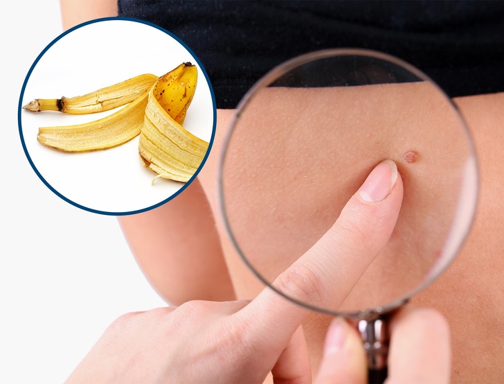 8 Effective Ways to Remove Skin Tags Naturally