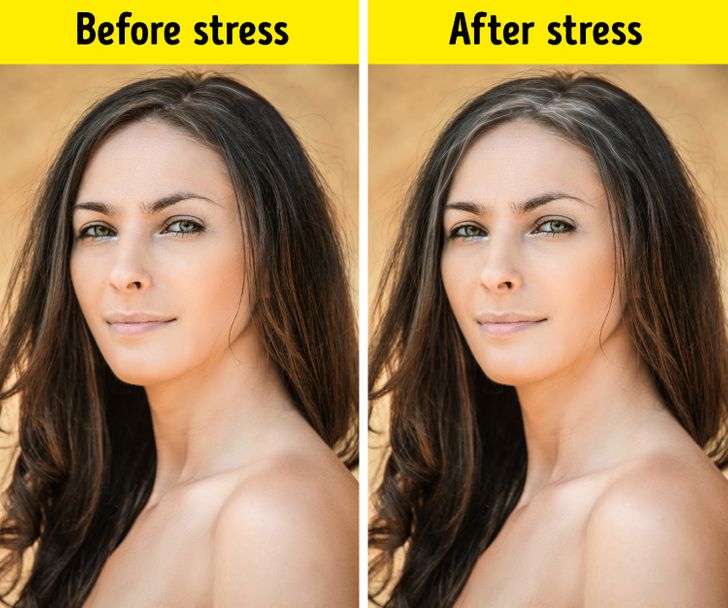 Hence Proved Stress Can Cause Greying Of Hair