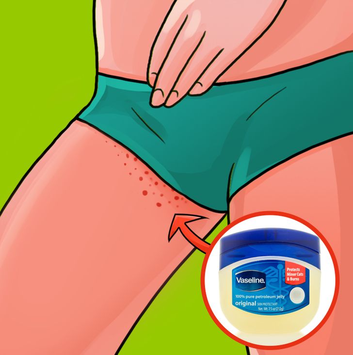 6 Effective Ways to Prevent a Rash on the Inner Thighs