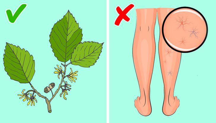 5 Natural Ways to Fight Spider and Varicose Veins