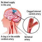 How to Recognize a Stroke and What to Do to Prevent Its Damaging ...