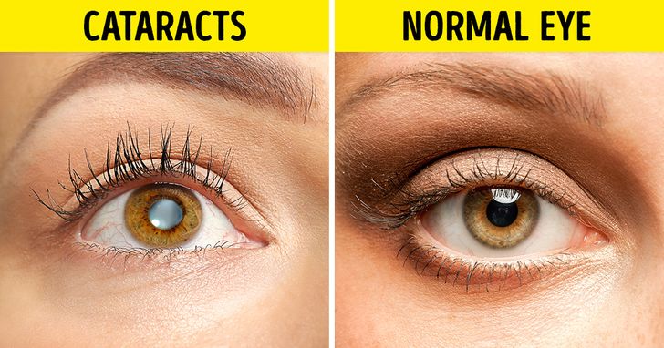 Eye Doctors Share Proven Tips for Those Who Want to Ditch Their Glasses