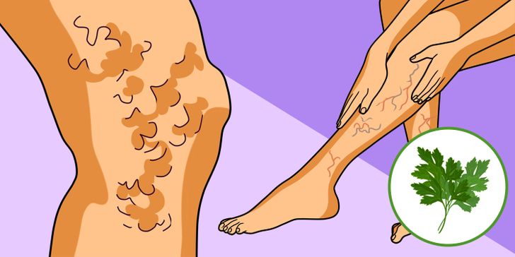 5 Natural Ways to Fight Spider and Varicose Veins