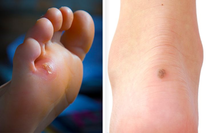 How I Fought Corns, Calluses, and Cracks on My Heels With Home Remedies