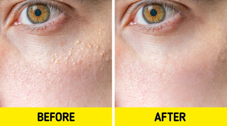 What Those Little White Bumps on Your Skin Are, and What to Do About Them