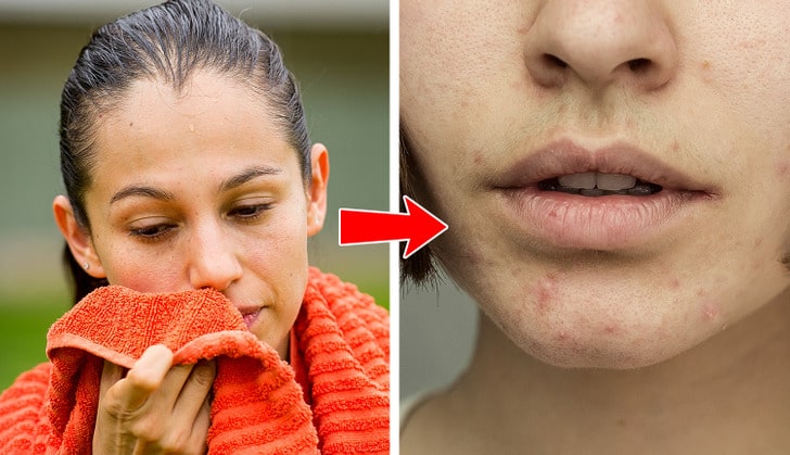 Qu’est-ce que l’acné sur 6 parties du corps essaie de vous dire sur vos habitudes de vie?